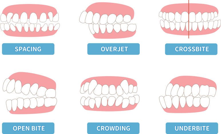 Diagram showing issues with spacing, overjet, crossbit, open bite, crowding and underbite